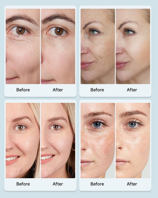 MOLAMOYA Led Light Therapy Mask